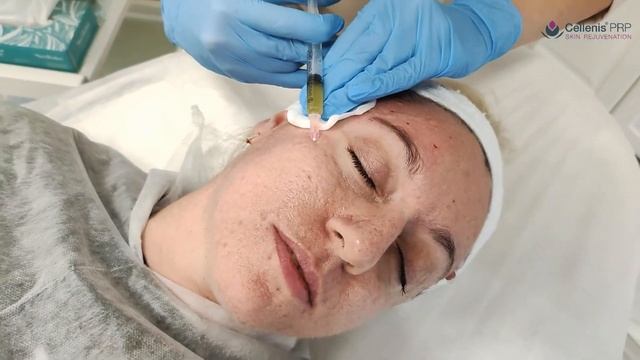 Процедура Cellenis PRP