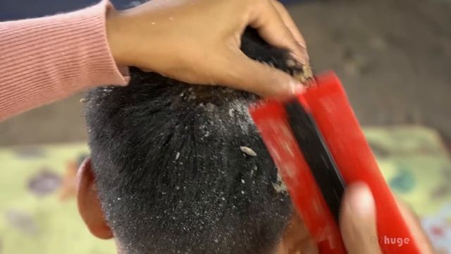 Satisfying And Picking Dandruff Big Flakes!! Psoriasis Dandruff Scratching Removal #312 смотреть онлайн