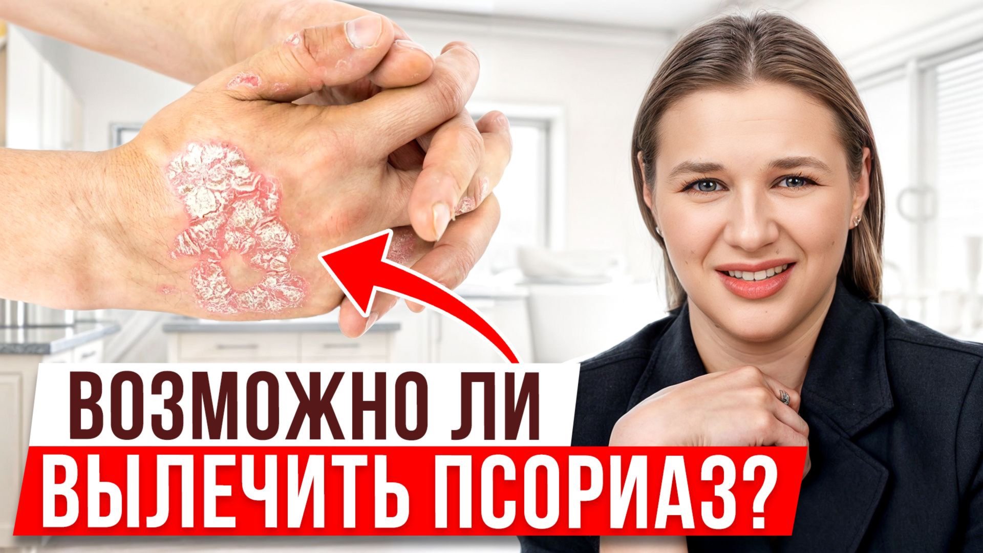 Проверь симптомы псориаза у себя! / Причины появления болезни смотреть онлайн