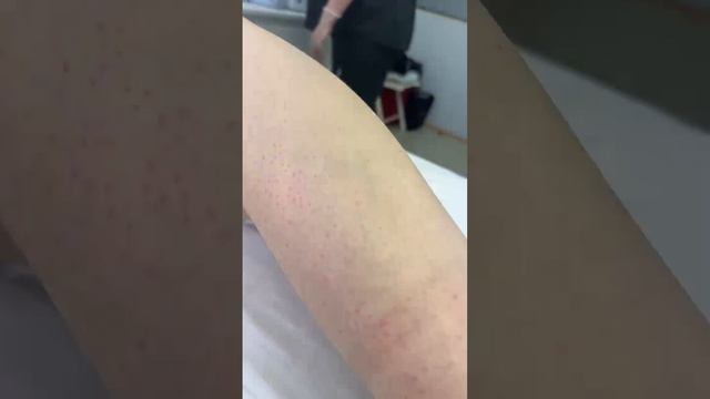 КАРБОНОВАЯ ДЕПИЛЯЦИЯ | ЗАПИСЬ ПРЯМОГО ЭФИРА ПО КАРБОНОВЫЙ ДЕПИЛЯЦИИ смотреть онлайн