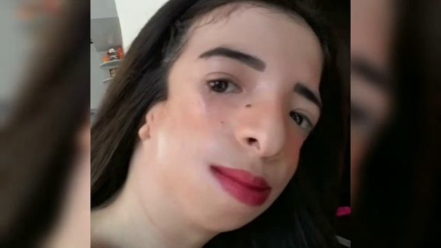 TREACHER COLLINS SYNDROME | CHINGKAY PATRICIO