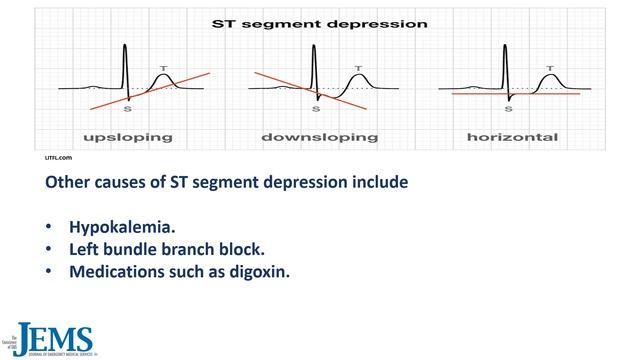 ECG 5 Minute Consult: 55yo Mother Found Semi-Comatose at Home смотреть онлайн