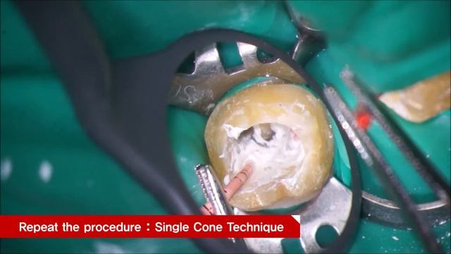 MEDICLUS Calcium Silicate Sealer MTA (One-Fill) ,Core build up (Any-core) смотреть онлайн