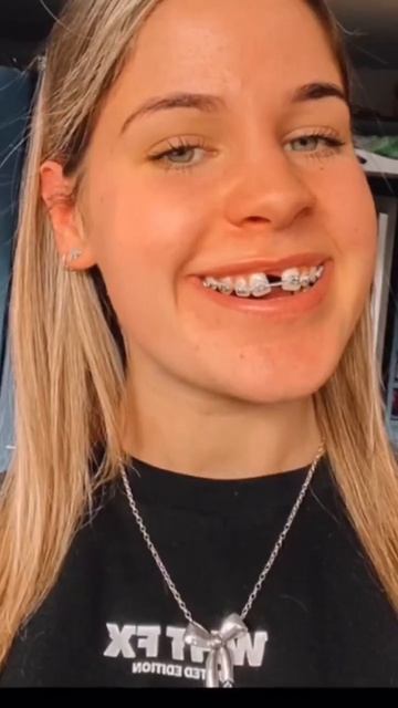 Central incisers gap (diastema), braces progress, Orthodontics #satisfying #dental #dentistry #teet смотреть онлайн