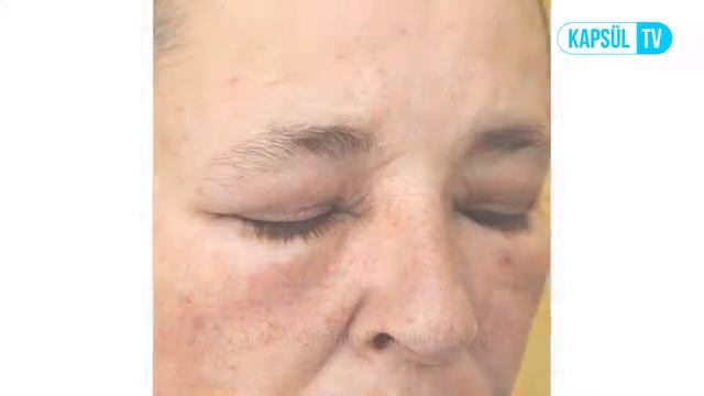 Gıda Alerjisinin Belirtileri Nelerdir? смотреть онлайн
