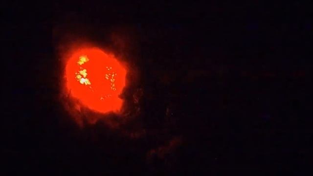 Ахалазия кардии, Achalasia Cardia смотреть онлайн