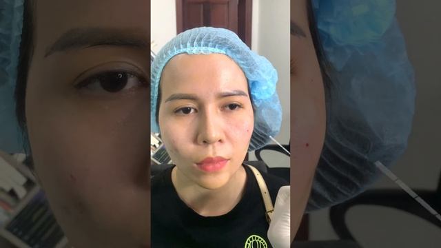 Dạy tiêm hốc mắt filler смотреть онлайн