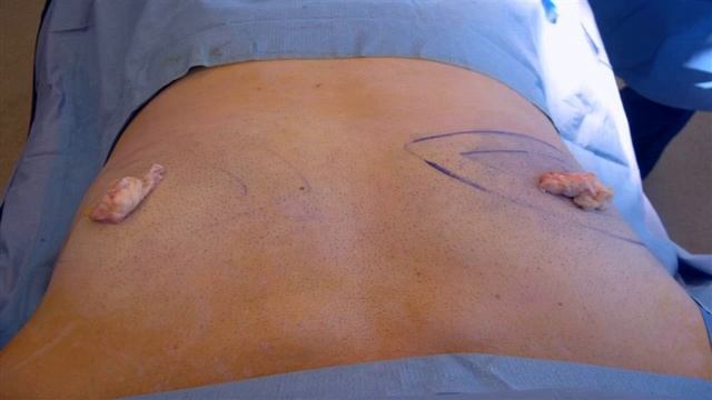 Transanal Minimally Invasive Surgery TAMIS resection of early rectal cancer смотреть онлайн