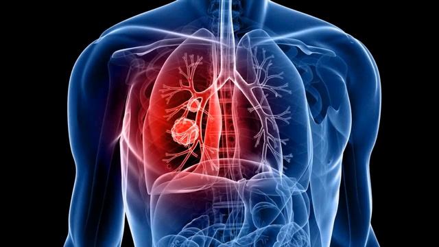 ARE THERE ANY ALTERNATIVE DIAGNOSTIC APPROACHES FOR MESOTHELIOMA?
