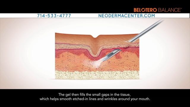 Belotero dermal filler feels natural to the touch смотреть онлайн