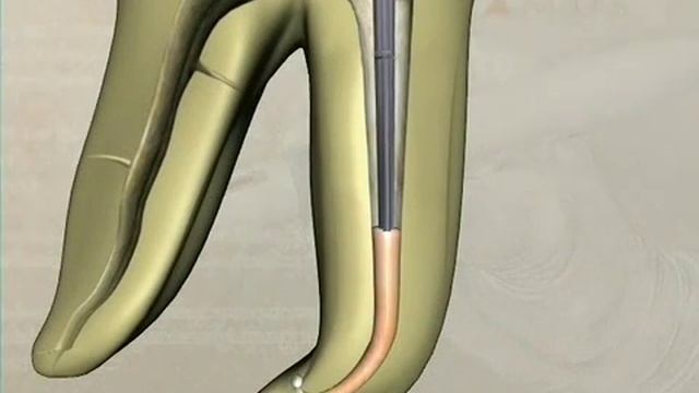 Backfilling a canal using Calamus | Dentsply Sirona смотреть онлайн