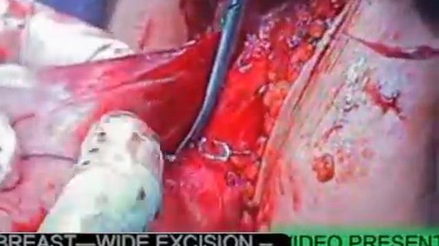 CYSTOSARCOMA PHYLLODES OF THE BREAST PROF. SHEETAL SINGH JAMMU смотреть онлайн