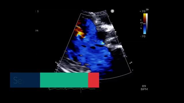 Mitral valve ERO смотреть онлайн