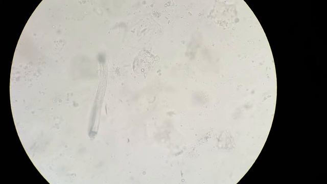 Strongyloides stercoralis larvae / ibn sina hospital . Kuwait смотреть онлайн