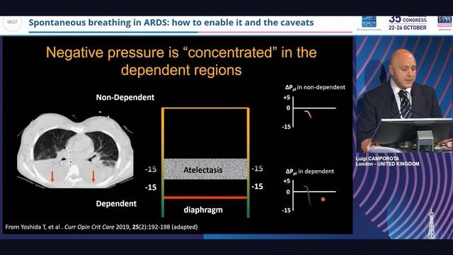 Spont breathing in ARDS how enable it and caveats Luigi Camporota 2022