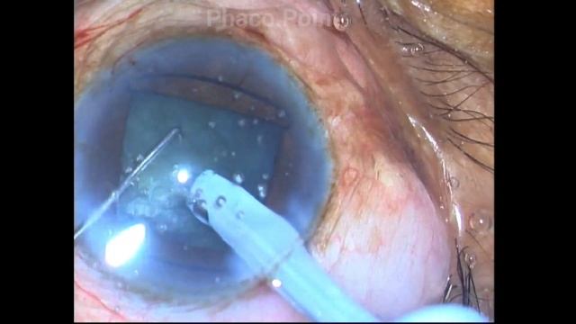The Gupta Pupil Dilating Ring - Initial Experience - A non rotating Nucleus management смотреть онлайн