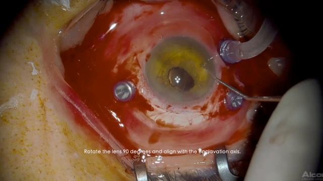 IOL fixations Techniques: Pros and Cons Retropupillary Iris-Fixated IOL with Artisan смотреть онлайн
