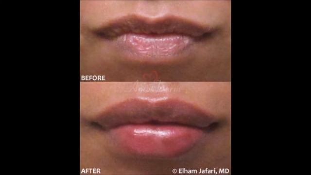 Lip Augmentation 👄 with Filler Injection @ Amoderm Cosmetic Clinic смотреть онлайн