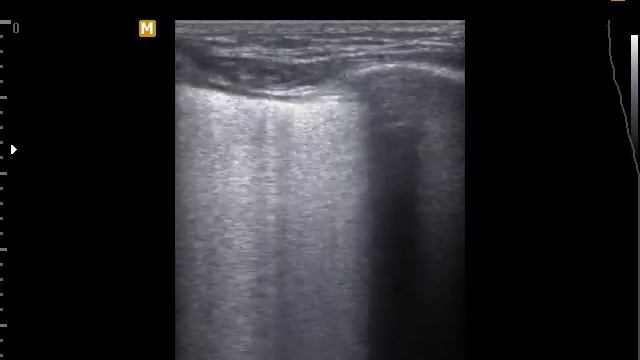 Case 234 : B-line ( Lung Ultrasound) смотреть онлайн