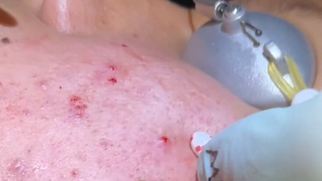Blackheads For Days Part 6.Extractions-blackheads,whiteheads, Milia, Ingrown Hairs Removed.MrPopZit