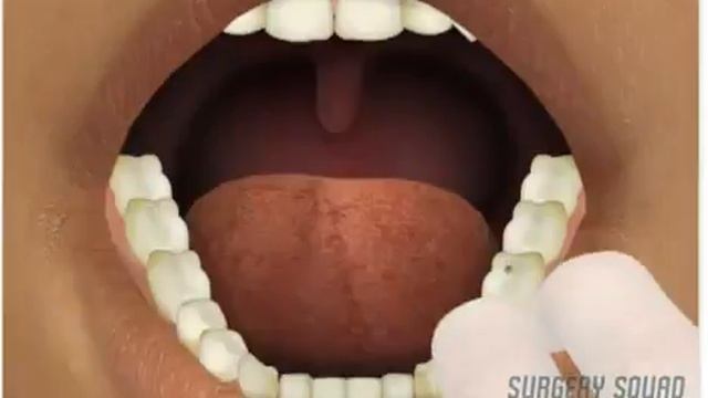 Amalgam Dental Filling смотреть онлайн