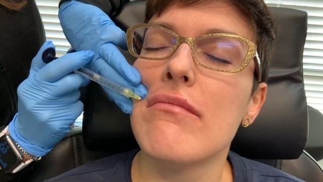 Lip Filler with Dr. Kerry Day-Krusniak смотреть онлайн