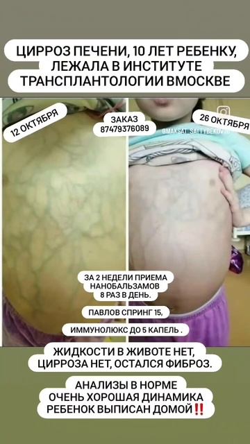 Жизнь продолжается. Цирроз печени лечение #нанобальзам #респект