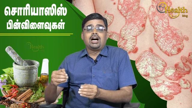 சோரியாசிஸ் பின்விளைவுகள் எப்படி இருக்கும்? | Dr. B. Mariraj BSMS , MD | Ph: 90470 - 81000 смотреть онлайн