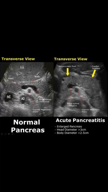 Acute Pancreatitis Ultrasound | Pancreas Normal Vs Abnormal USG #shorts | #ultrasound | #radiology смотреть онлайн