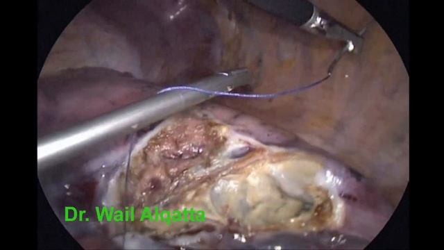 Thoracoscopic Endocystectomy of Right Lung Hydatid Cyst смотреть онлайн