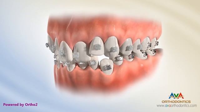 Self Ligating Braces - Clear or Ceramic смотреть онлайн