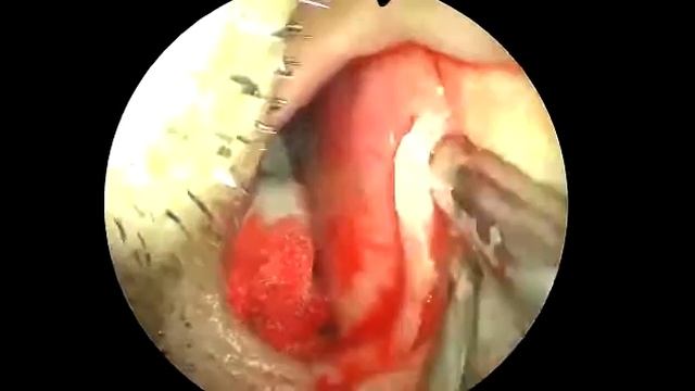 Nose surgery OM 822A SD Medical Endoscope Camera смотреть онлайн