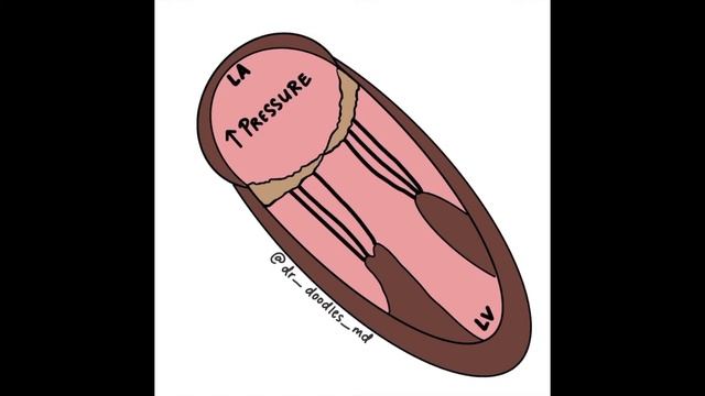 Mitral Stenosis Opening Click смотреть онлайн