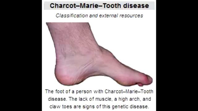 Charcot Marie Tooth Disease - Hereditary Motor and Sensory Neuropathy (HMSN) смотреть онлайн