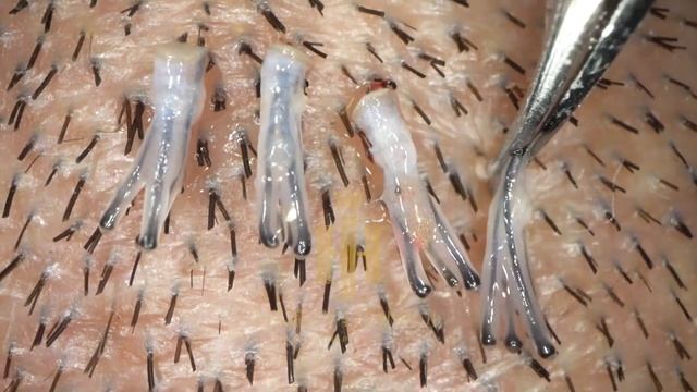 Hair root close-up Video #hair#transplant#fuemethod#laowa#lens смотреть онлайн