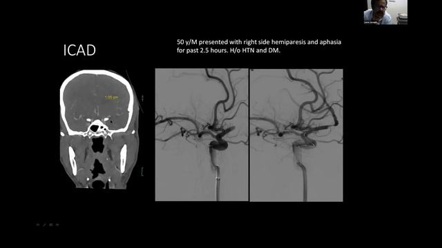 Dr. Leve Joseph - Advanced Stroke Imaging