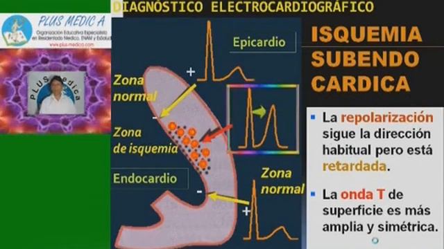 Pls med cardiologia - 3 CARDIOLOGIA a base de preguntas 3 смотреть онлайн