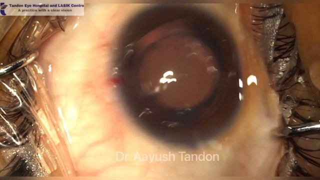 IPCL Toric Implantation For High Myopia