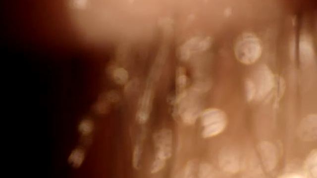 Pthiriasis - 1 week followup смотреть онлайн