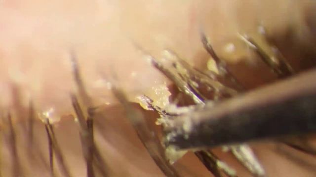 Demodex Blepharitis Scurf Removed - So Many Arachnids! смотреть онлайн