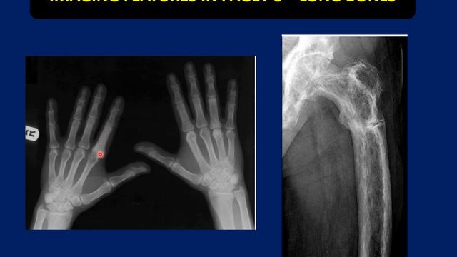 6th RCS: Polyostotic Paget's disease with secondary degeneration - Dr John Robert смотреть онлайн