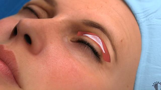 Блефароластика смотреть онлайн