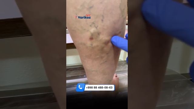 Ikkala oyoqlar varikozida o'tkazilgan evlo amaliyoti смотреть онлайн