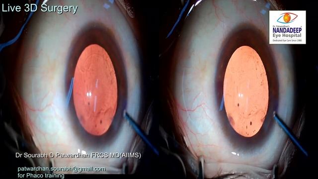 High myopia Live 3D surgery from Nandadeep Eye Hospital Dr Sourabh Patwardhan смотреть онлайн