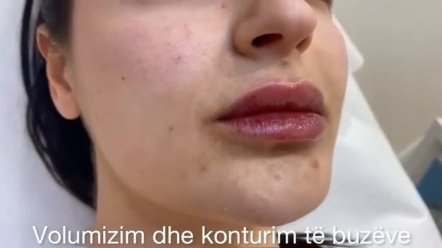 Best lip filler👄 смотреть онлайн