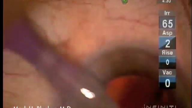 Crystalens Implantation смотреть онлайн