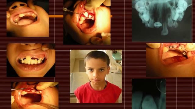 Developmental Disturbances of teeth - Dr Ghousia смотреть онлайн