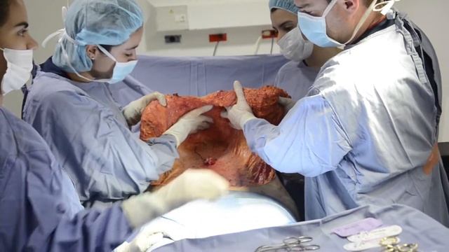 Tummy Tuck, Liposuction: Surgical Procedure (Español) смотреть онлайн