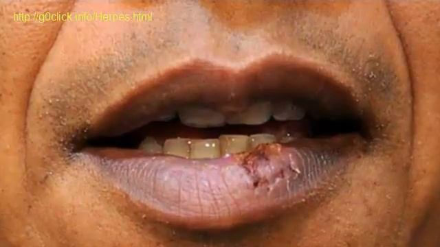 How To Get Rid Of Cold Sores On Lip Fast смотреть онлайн