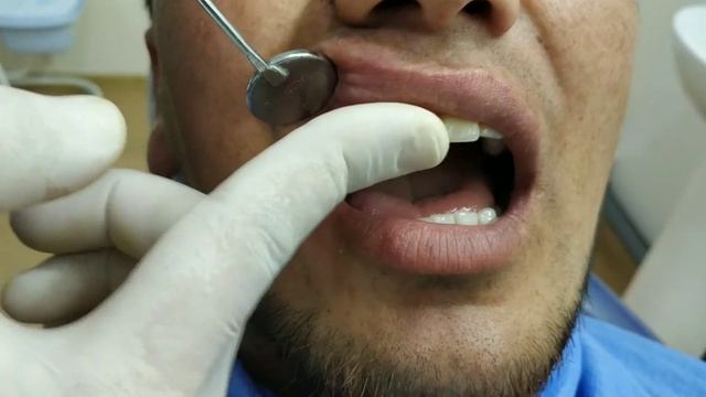 МИКРОПРОТЕЗ ТЕЗ КУНДА ТИШ УРНАТИШ